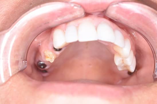 Slider image (8) Dental Implants in Colombia Dr Johanna Calderon